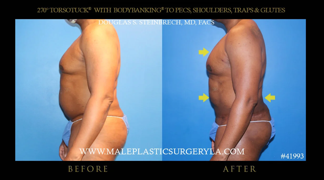 Torsotuck - Before & After Photos