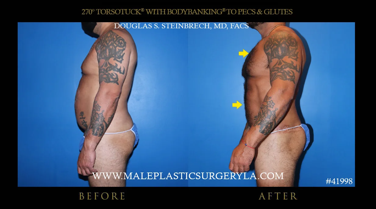 Torsotuck - Before & After Photos