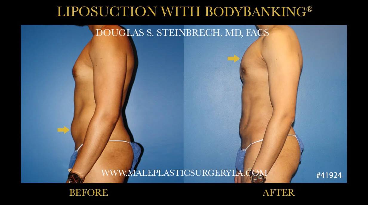 Liposuction - Before & After Photos