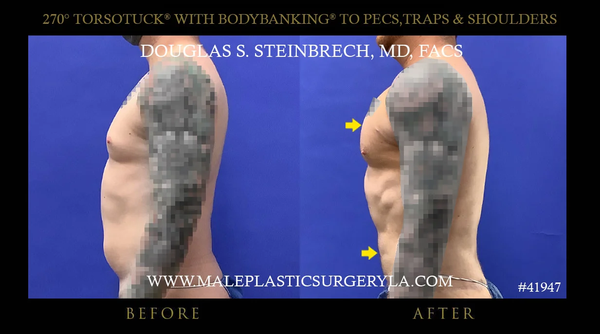 Torsotuck - Before & After Photos