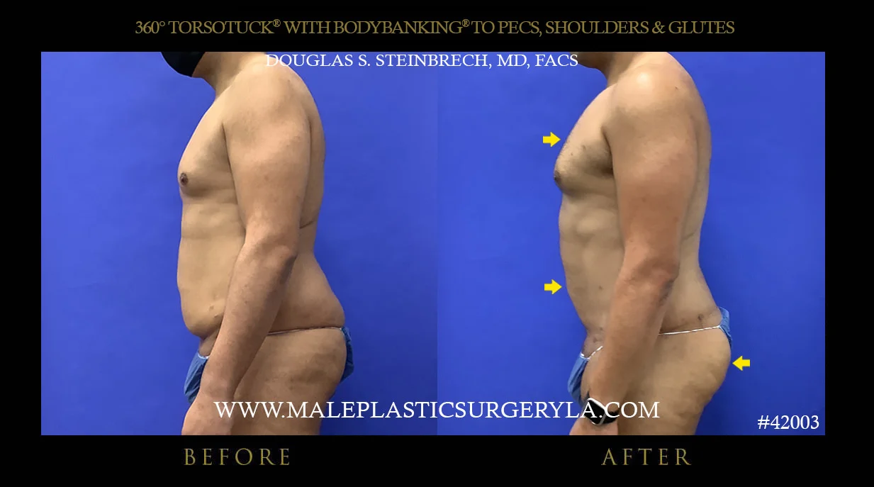 Torsotuck - Before & After Photos