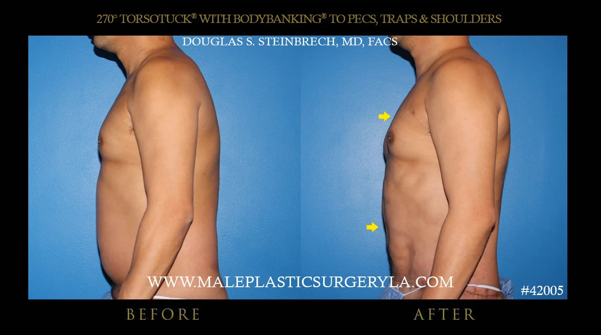 Torsotuck - Before & After Photos