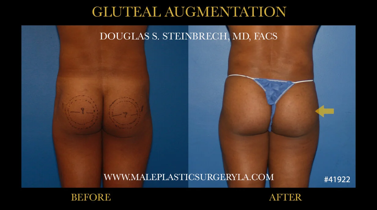 Gluteal Buttock Implants - Before & After Photos