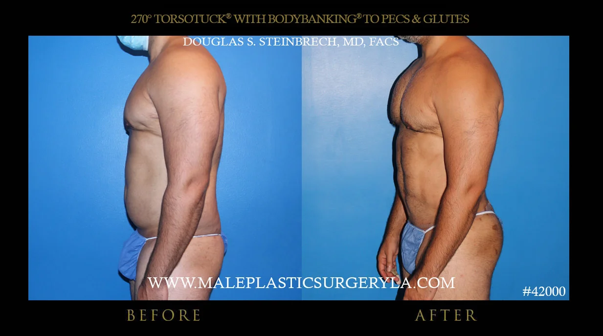 Torsotuck - Before & After Photos