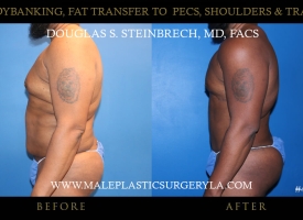 Liposuction - Before & After Photos