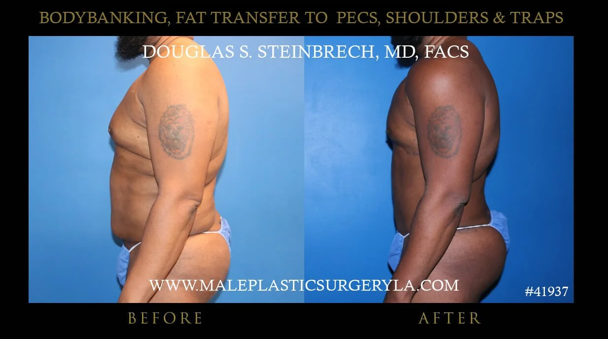 Liposuction - Before & After Photos