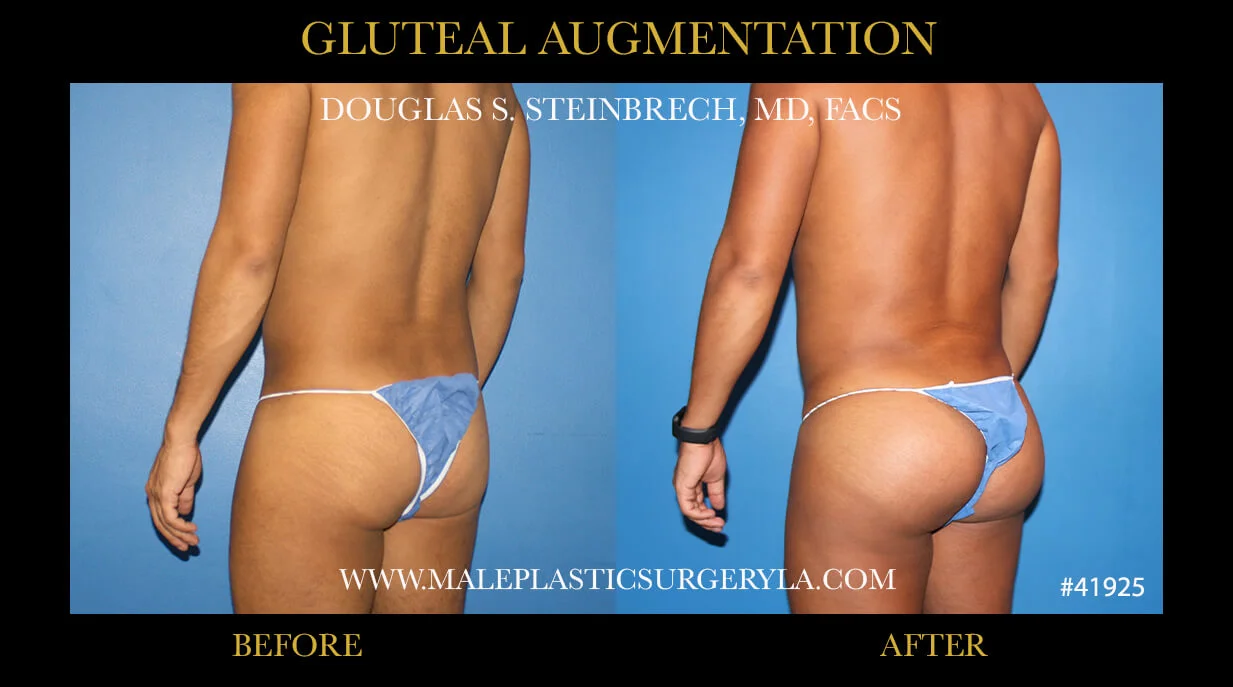 Gluteal Buttock Implants - Before & After Photos