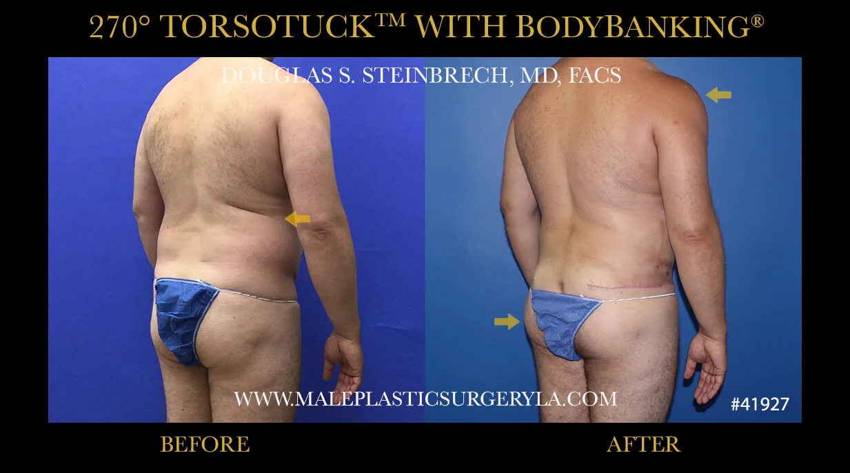 Torsotuck - Before & After Photos