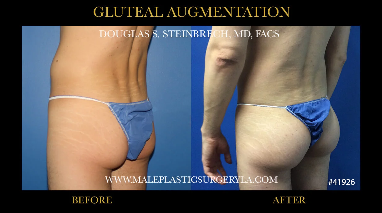 Gluteal Buttock Implants - Before & After Photos