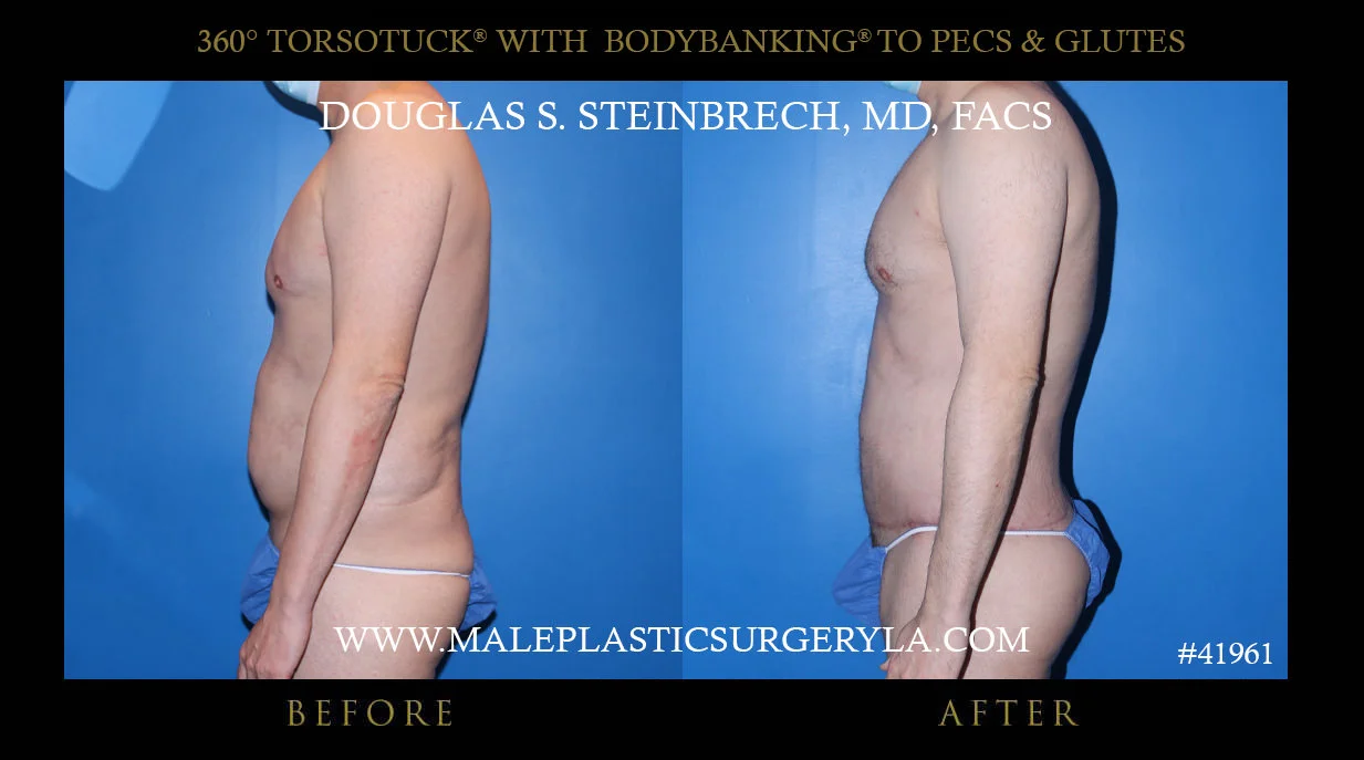 Torsotuck - Before & After Photos