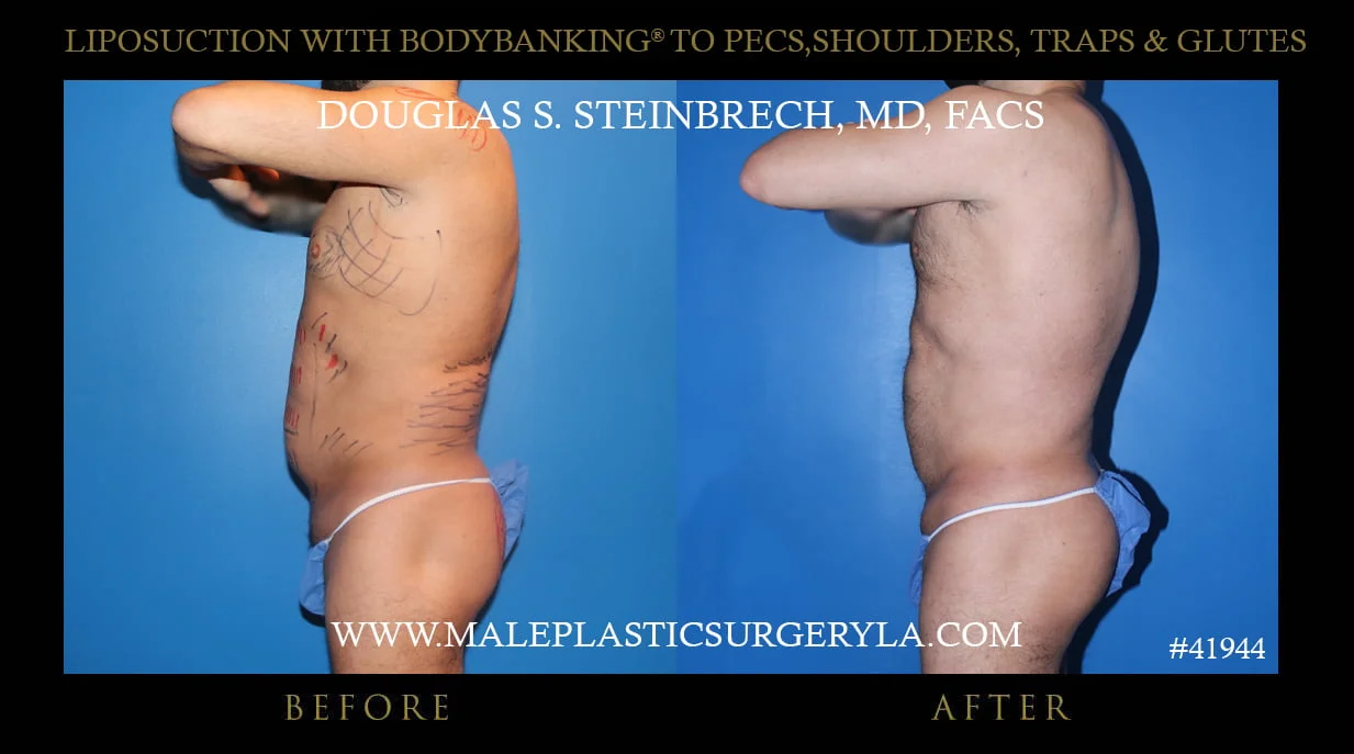 Liposuction - Before & After Photos