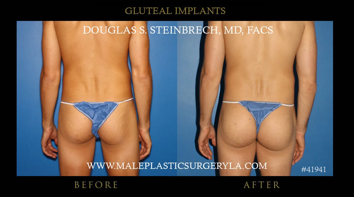 Gluteal Buttock Implants - Before & After Photos