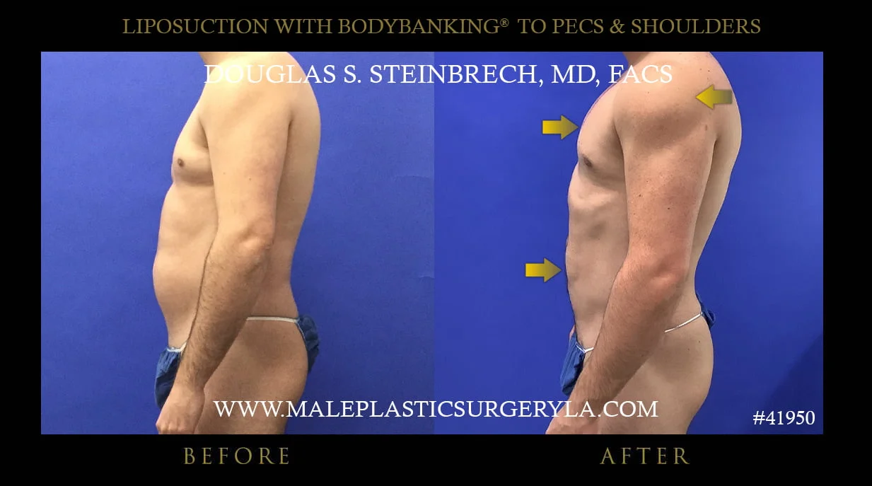 Liposuction - Before & After Photos