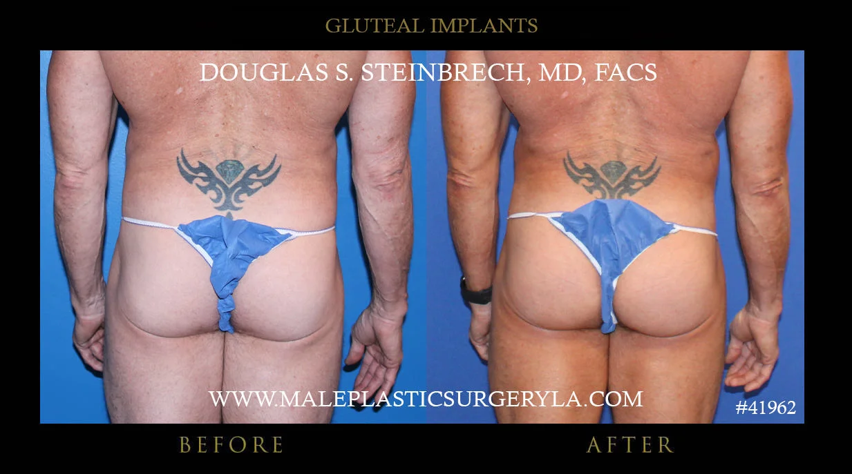 Gluteal Buttock Implants - Before & After Photos