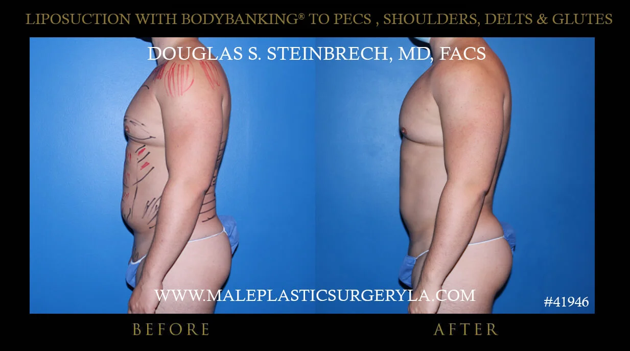 Liposuction - Before & After Photos