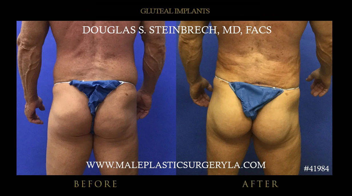 Gluteal Buttock Implants - Before & After Photos