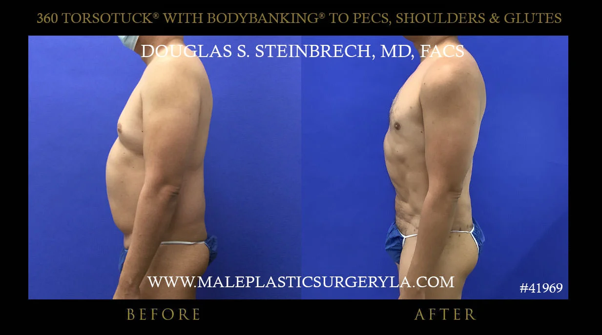 Torsotuck - Before & After Photos