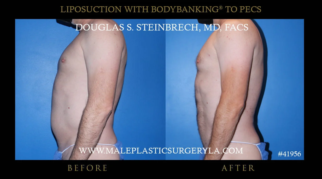 Liposuction - Before & After Photos