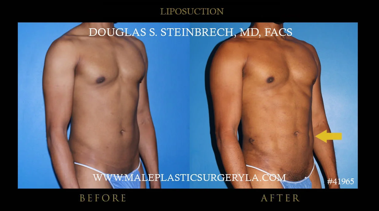 Liposuction - Before & After Photos