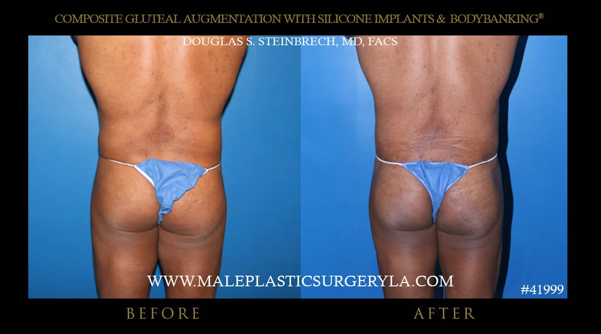 Gluteal Buttock Implants - Before & After Photos