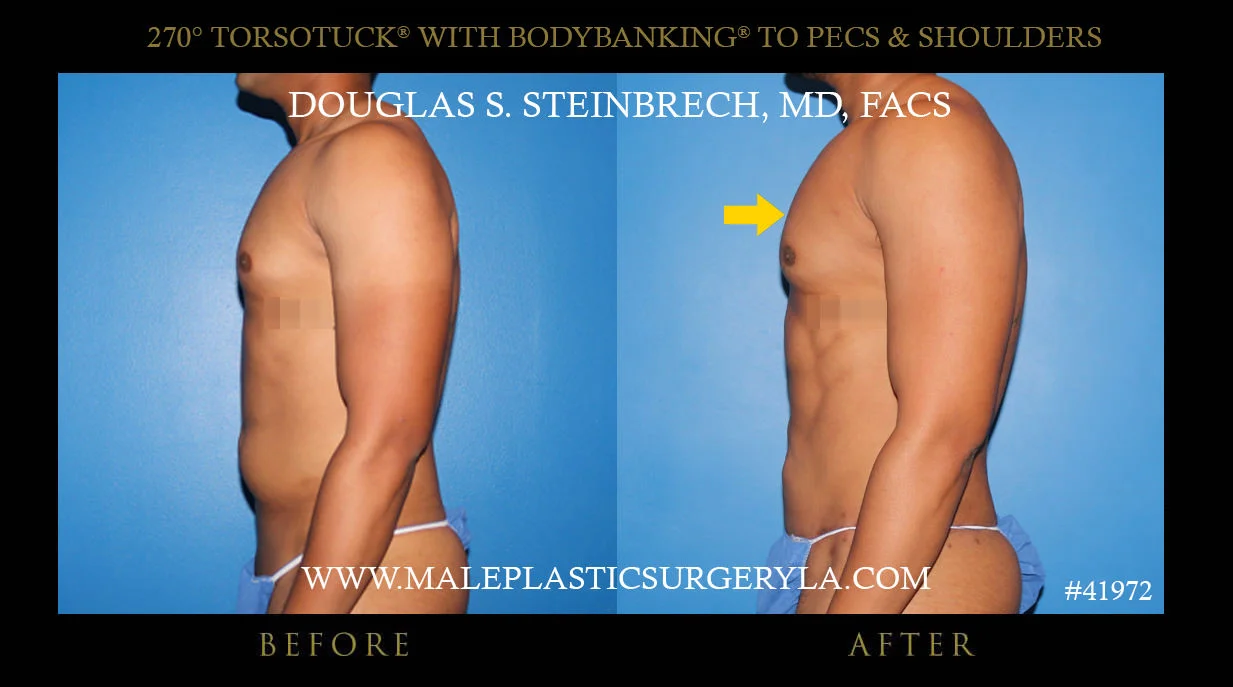 Torsotuck - Before & After Photos