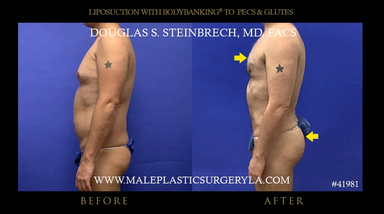 Liposuction - Before & After Photos