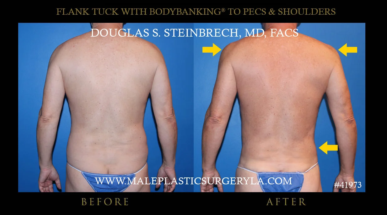 Torsotuck - Before & After Photos