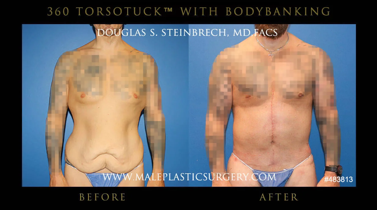 Torsotuck - Before & After Photos