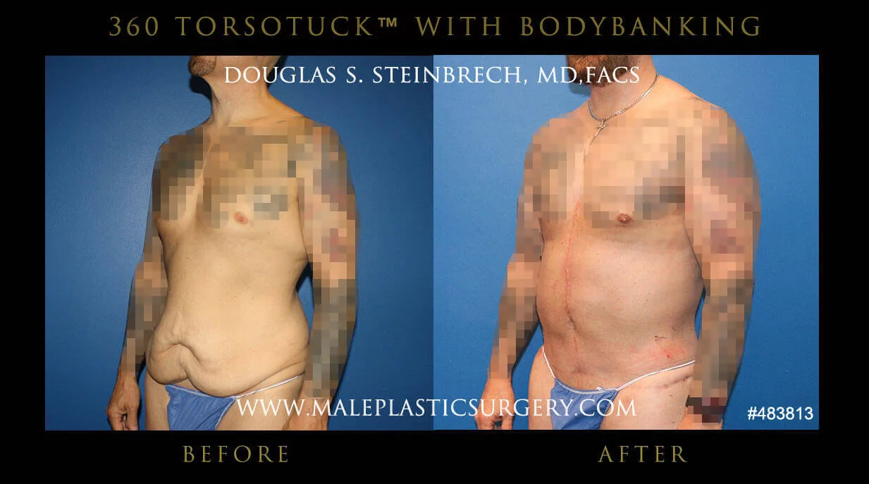 Torsotuck - Before & After Photos