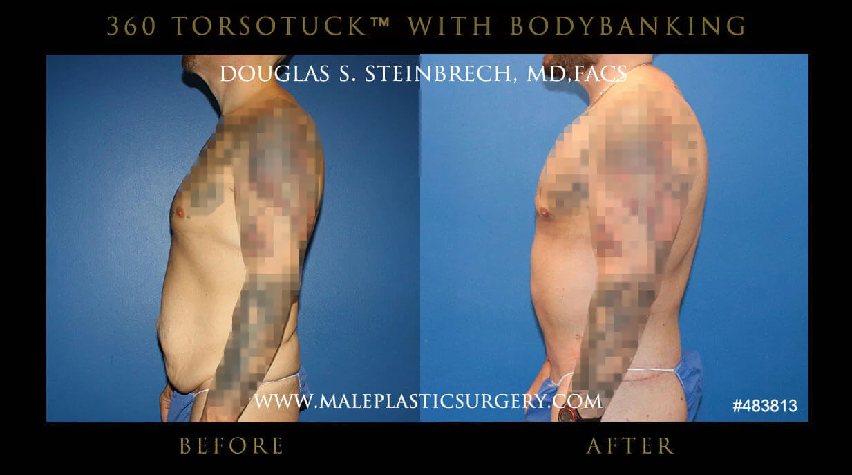 Torsotuck - Before & After Photos