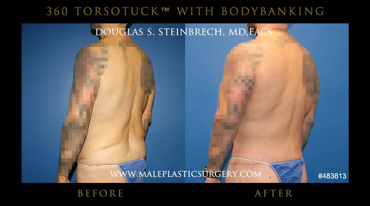 Torsotuck - Before & After Photos