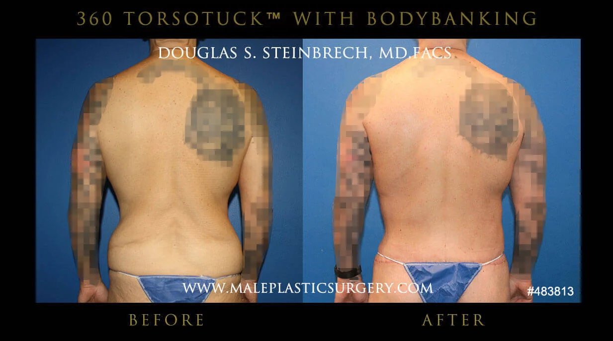 Torsotuck - Before & After Photos