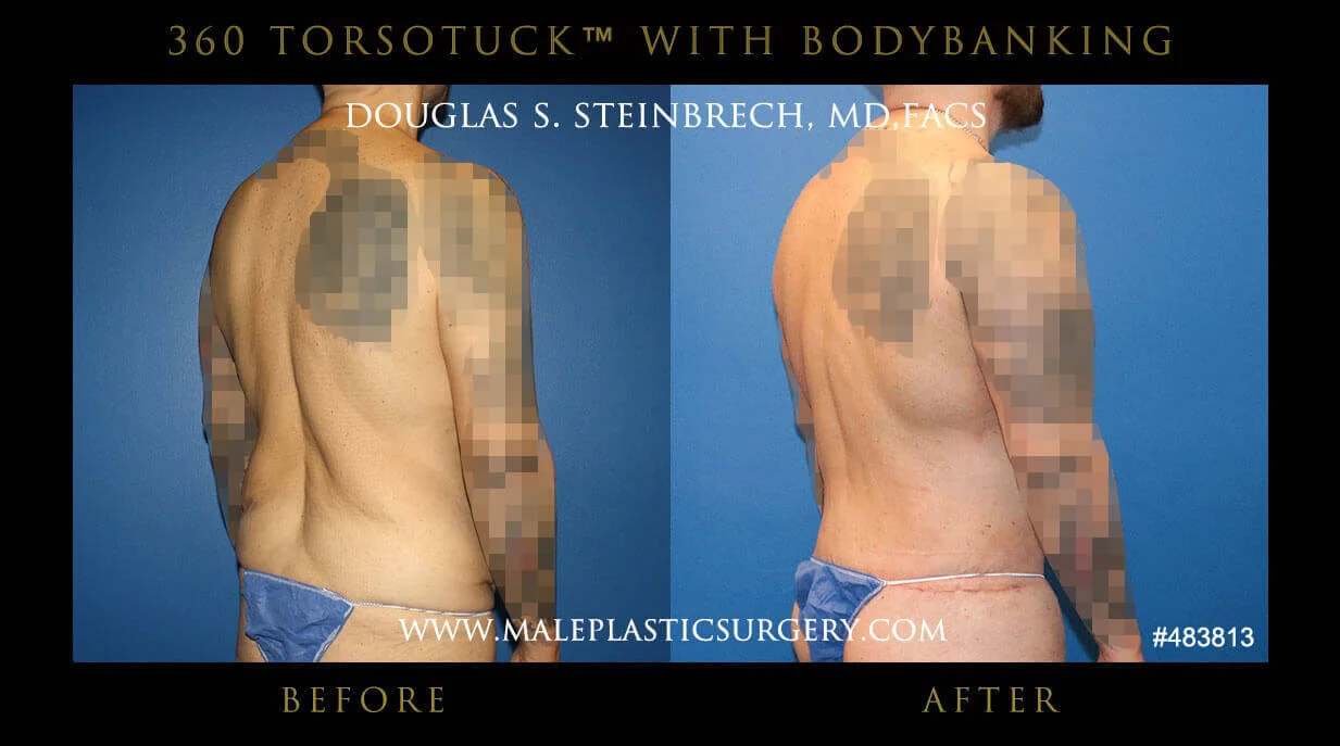 Torsotuck - Before & After Photos