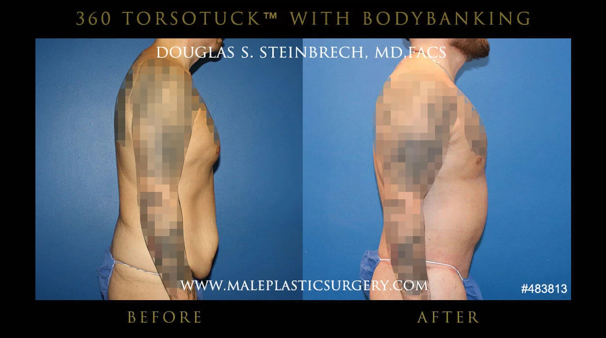 Torsotuck - Before & After Photos