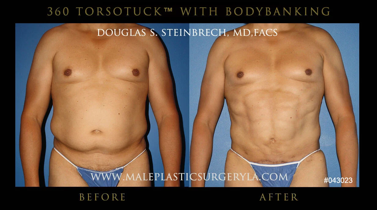 Torsotuck - Before & After Photos