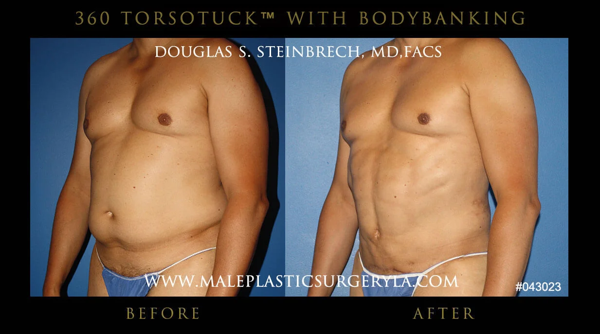 Torsotuck - Before & After Photos