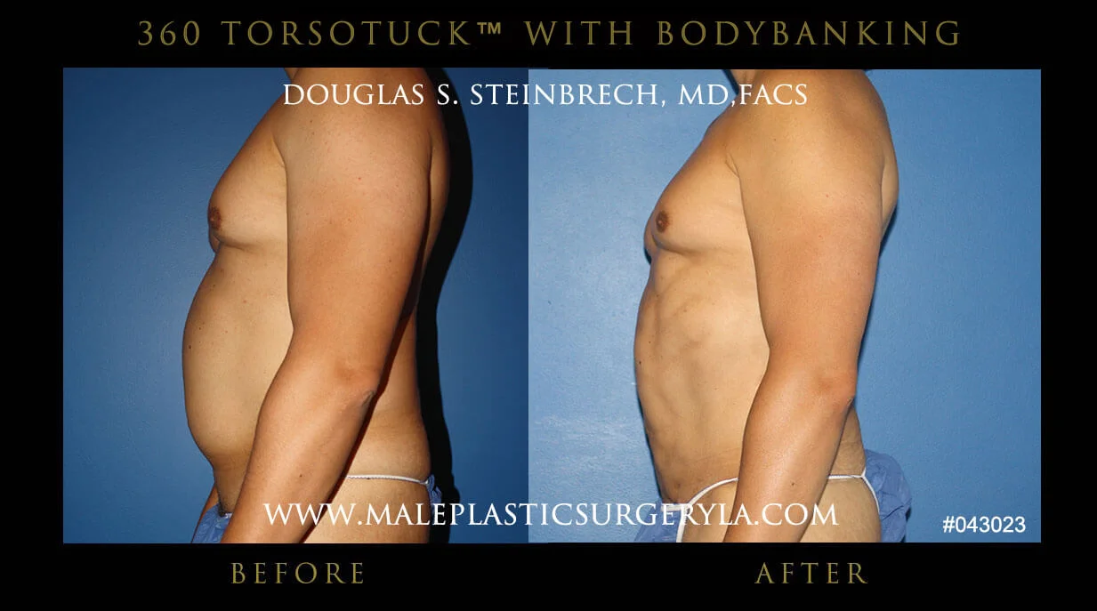 Torsotuck - Before & After Photos