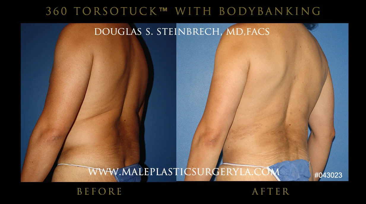 Torsotuck - Before & After Photos