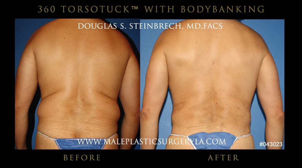 Torsotuck - Before & After Photos