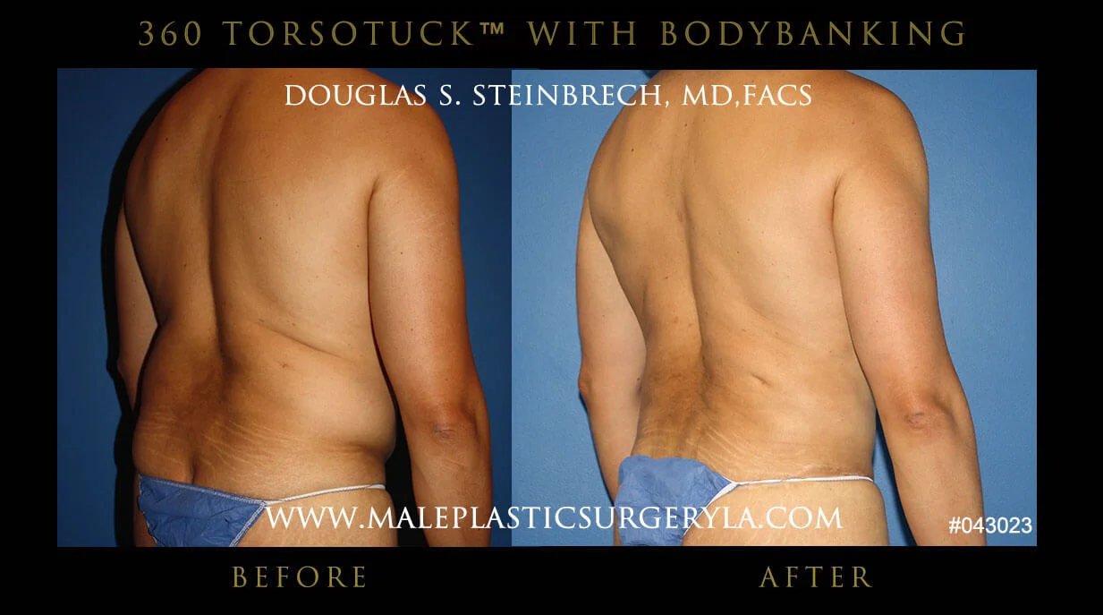 Torsotuck - Before & After Photos