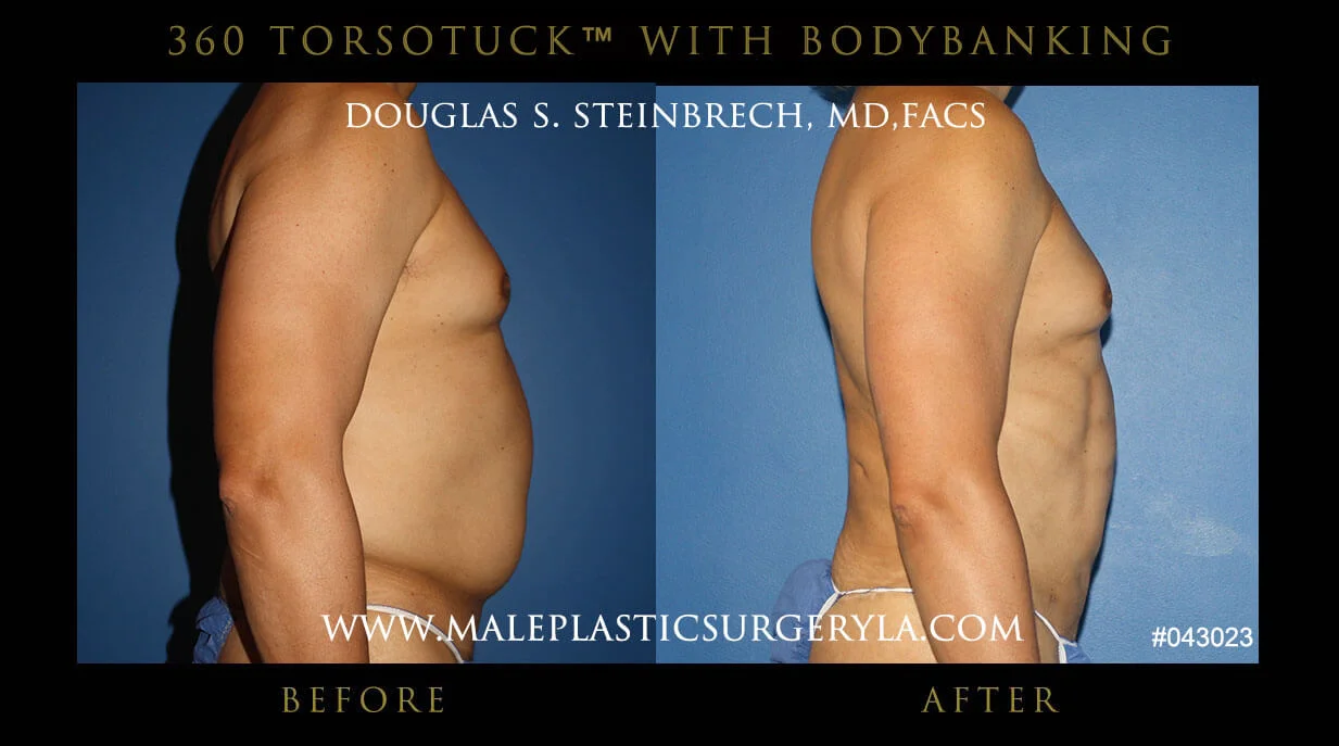 Torsotuck - Before & After Photos