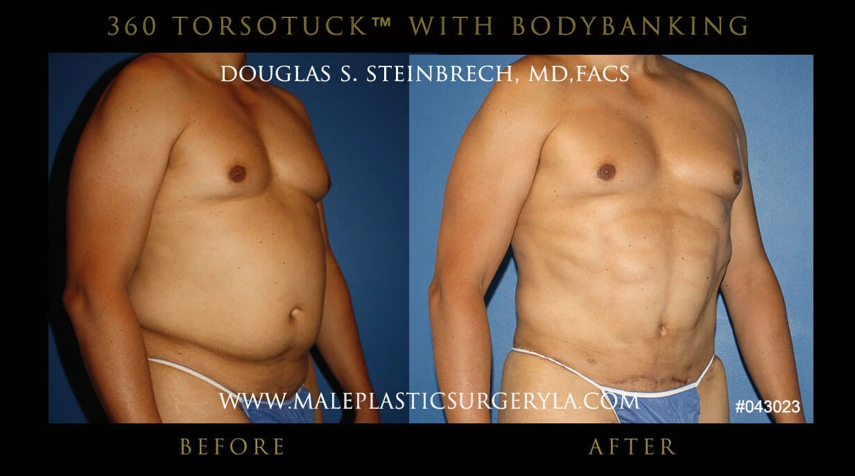 Torsotuck - Before & After Photos