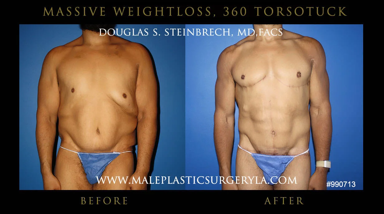 Torsotuck - Before & After Photos