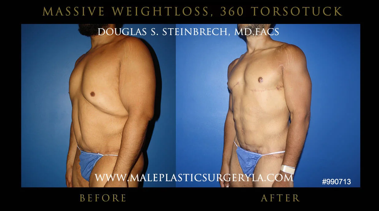 Torsotuck - Before & After Photos