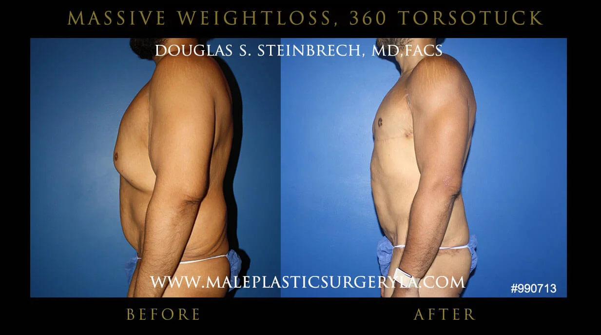 Torsotuck - Before & After Photos