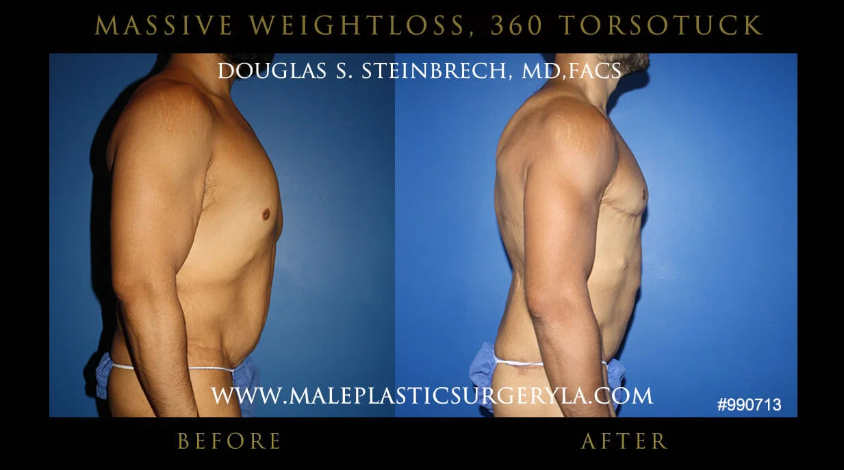 Torsotuck - Before & After Photos