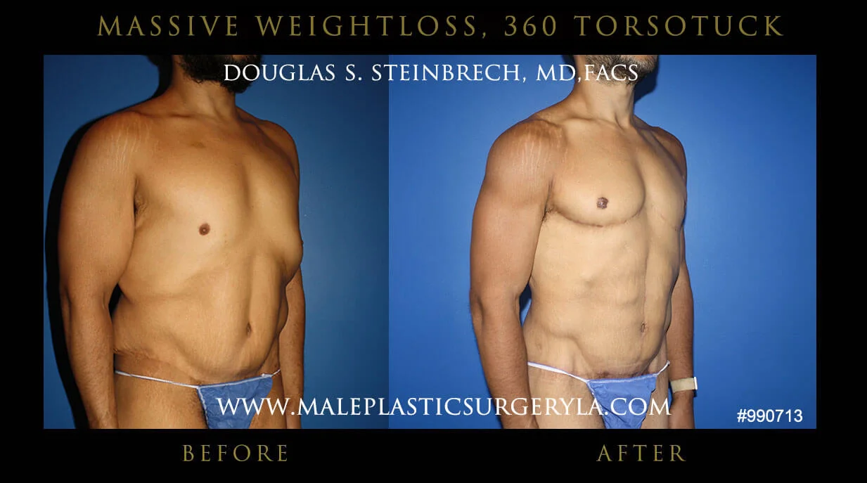 Torsotuck - Before & After Photos