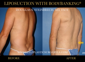 Liposuction - Before & After Photos