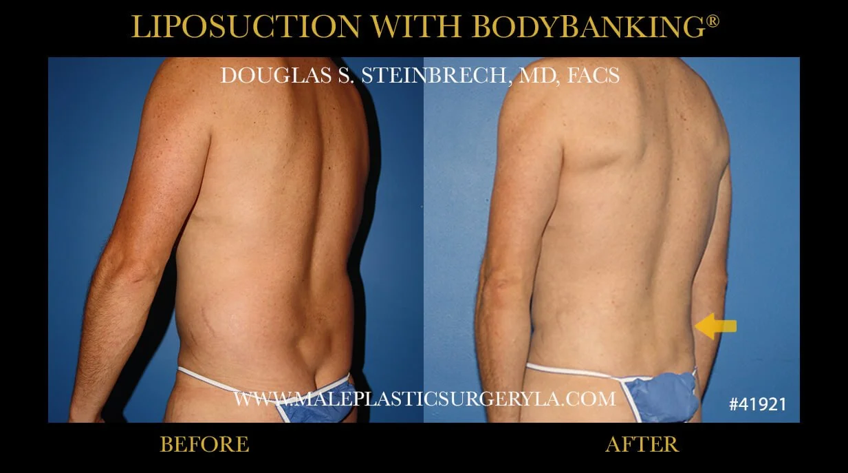 Liposuction - Before & After Photos