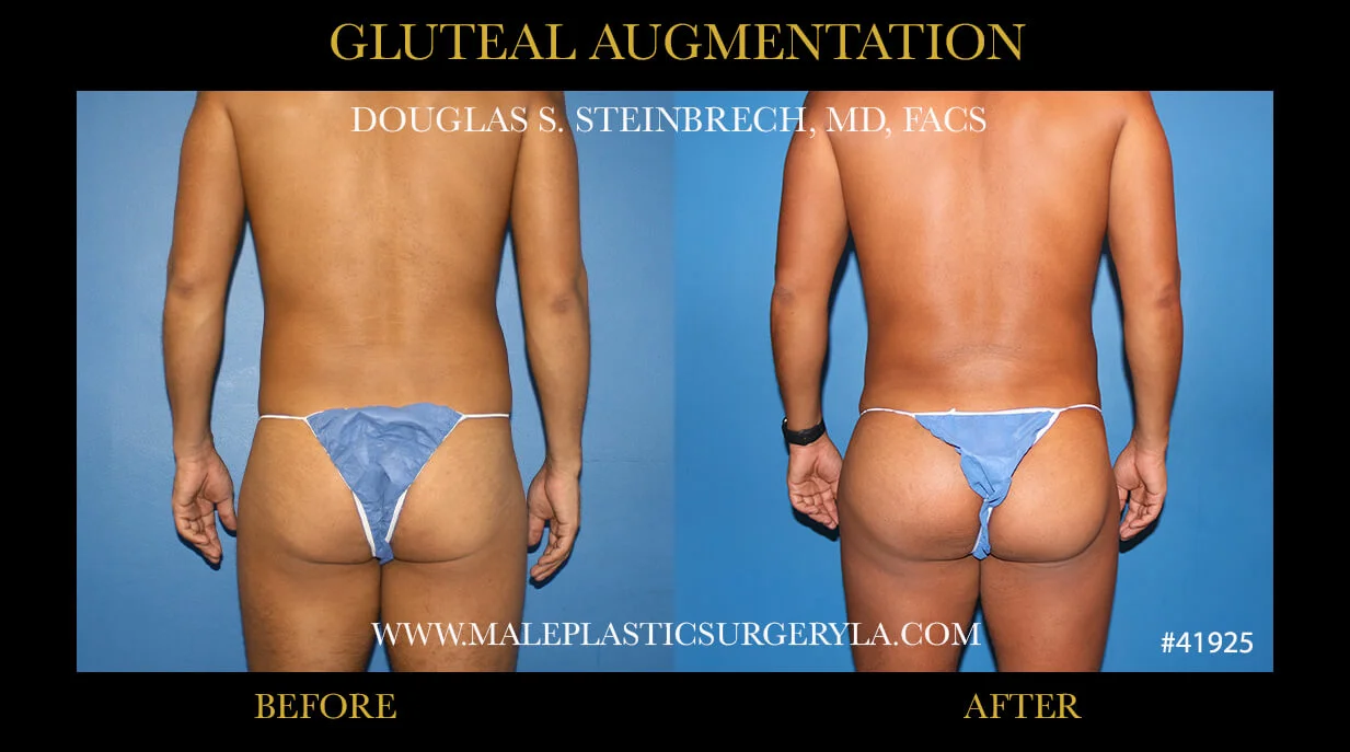 Gluteal Buttock Implants - Before & After Photos